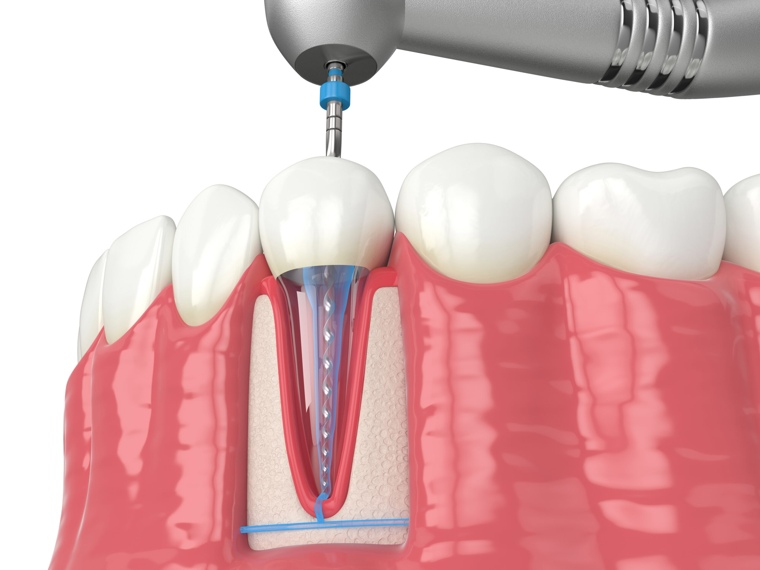Understanding Endodontic Treatment: Types, Benefits, and Solutions