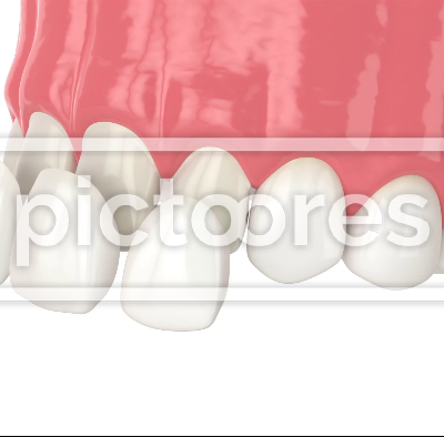 Upper jaw with installing dental veneers