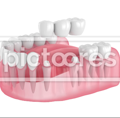 360 degrees rotation of jaw with dental bridge