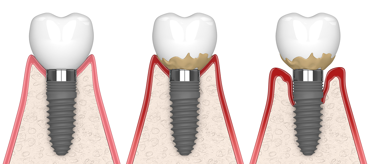 Dental Implants: Understanding the Risks and Disease