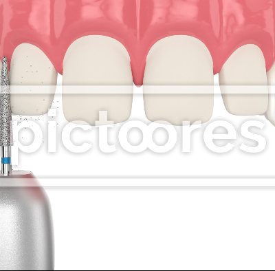 veneers placement procedure