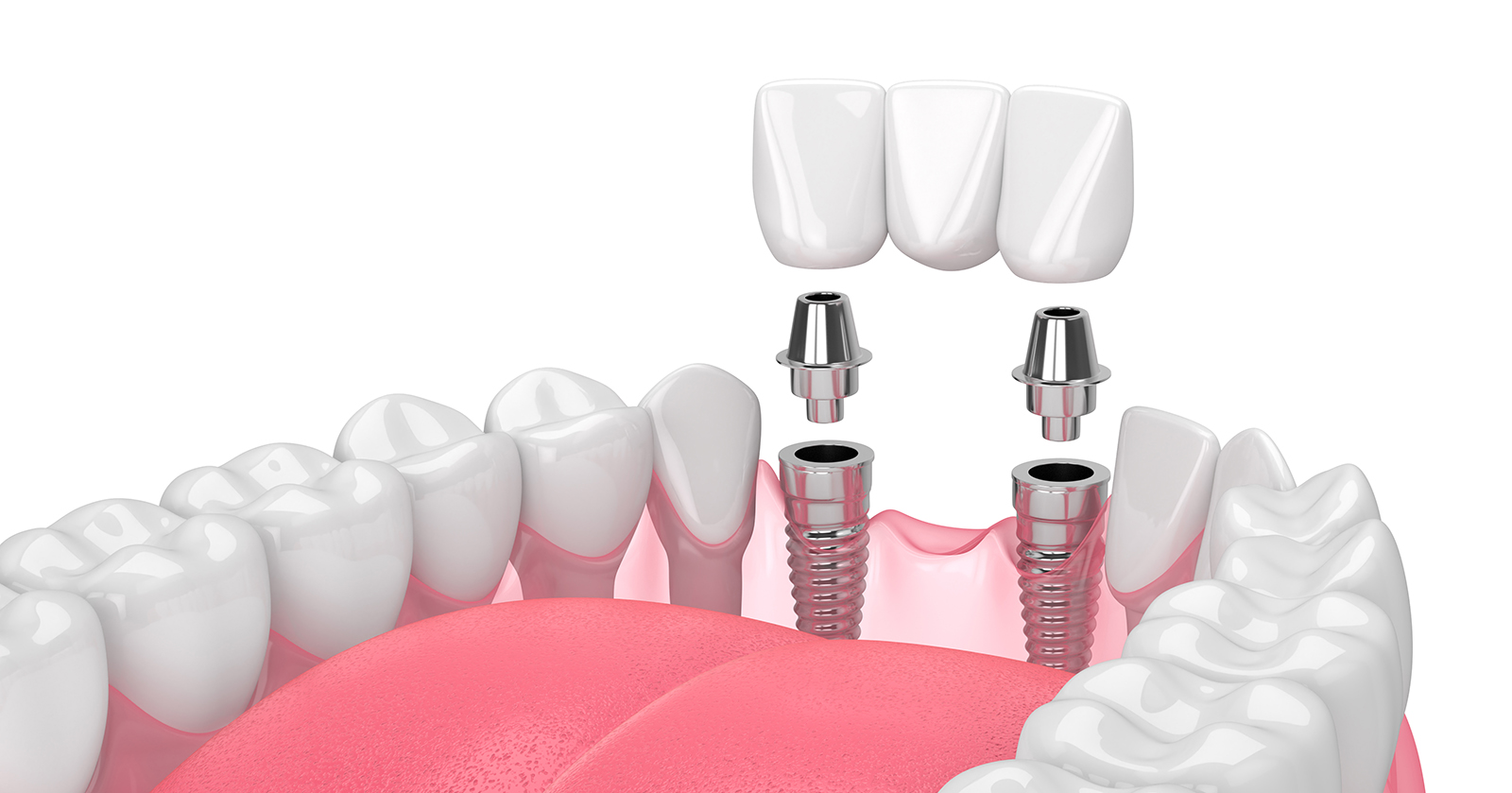 All You Need to Know About Dental Bridges