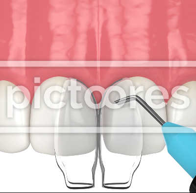 diastema closure by dental bonding procedure