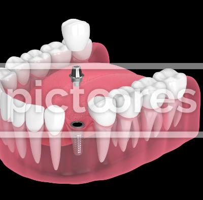 jaw with dental implant