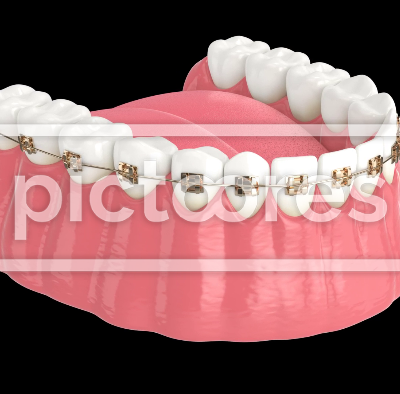 jaw with dental orthodontic braces