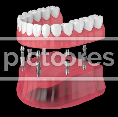 all-on-6 denture