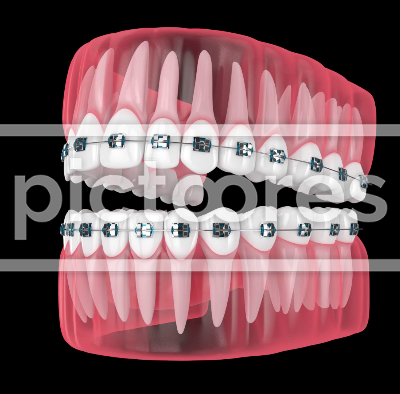 orthodontic braces