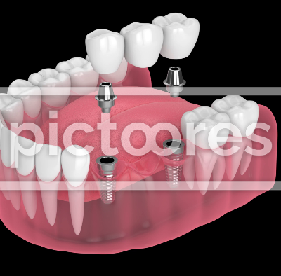 Jaw with implants supporting dental bridge over black background