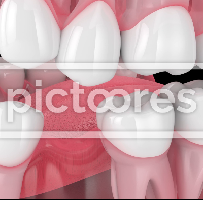 Teeth sliding towards the area of missing tooth