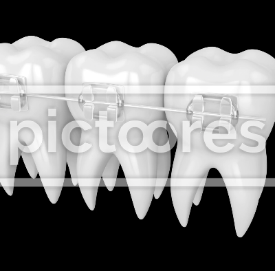 Teeth with clear orthodontic braces over black background