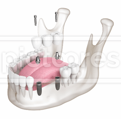 Screw-retained dental bridge on two implants in the mandible
